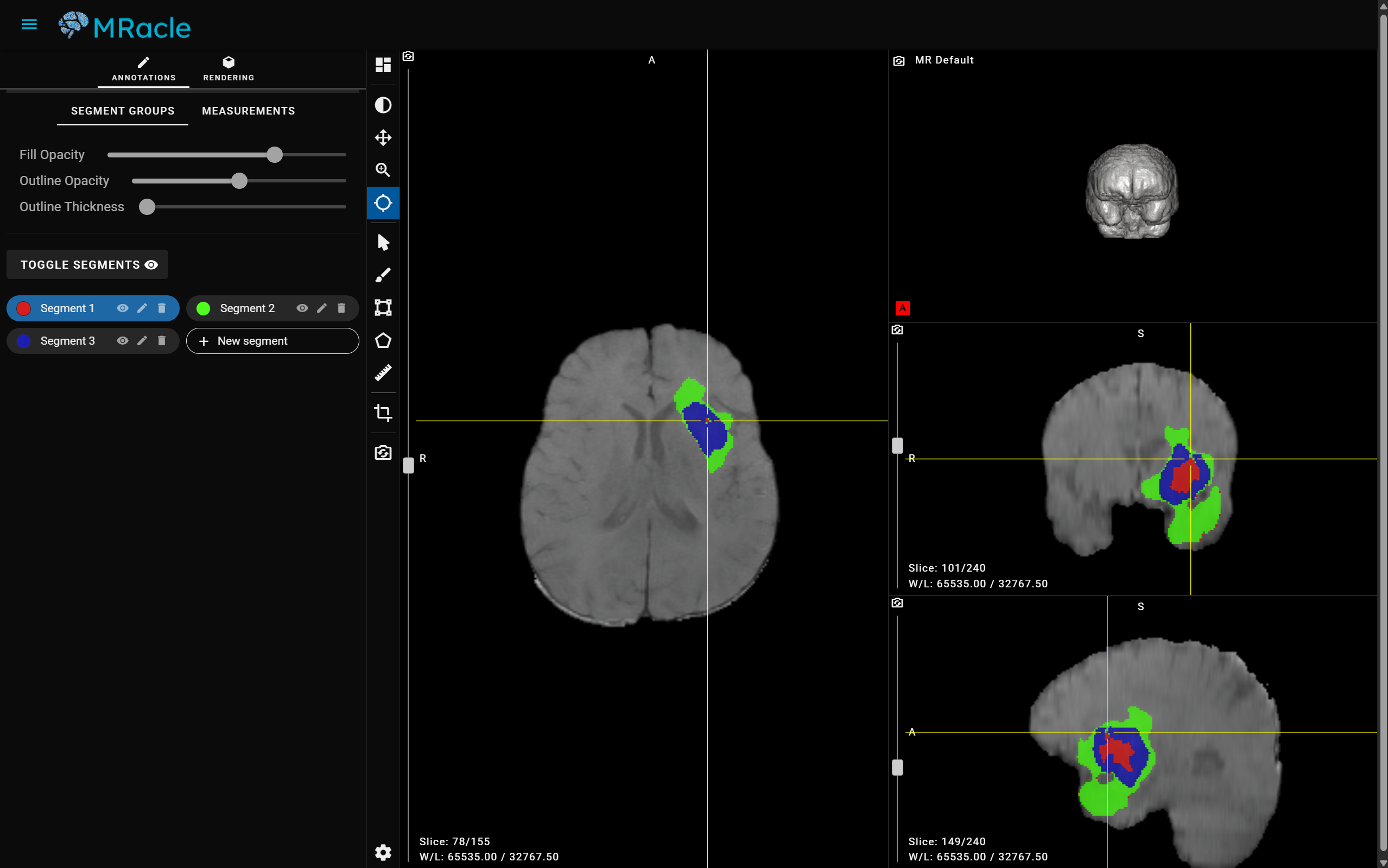 MRacle AI-powered tumor segmentation view